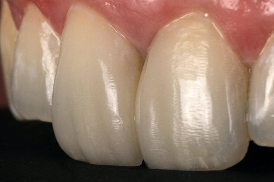 Fig. 15: Final polishing and super polishing with SuperBuff impregnated polishers completed after 7 days during the recall visit.