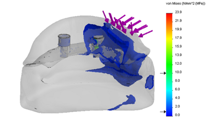 Numeryczna weryfikacja problematyki mocowania protezy całkowitej dolnej wspartej o 1 lub 2 wszczepy