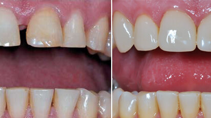 Carillas prefabricadas en dientes anteriores