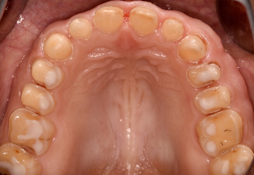 Fig. 6a: Tooth preparation in the upper jaw.