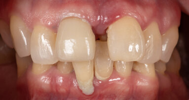 Digital technology for full-arch implant prostheses