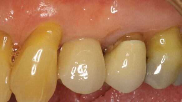 Esthetics with implants: Platform switching