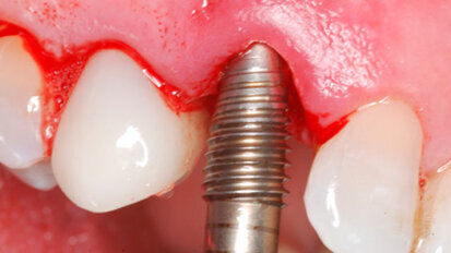 Άμεση τοποθέτηση εμφυτεύματος με οστεοτόμους Paltop για οστική διεύρυνση