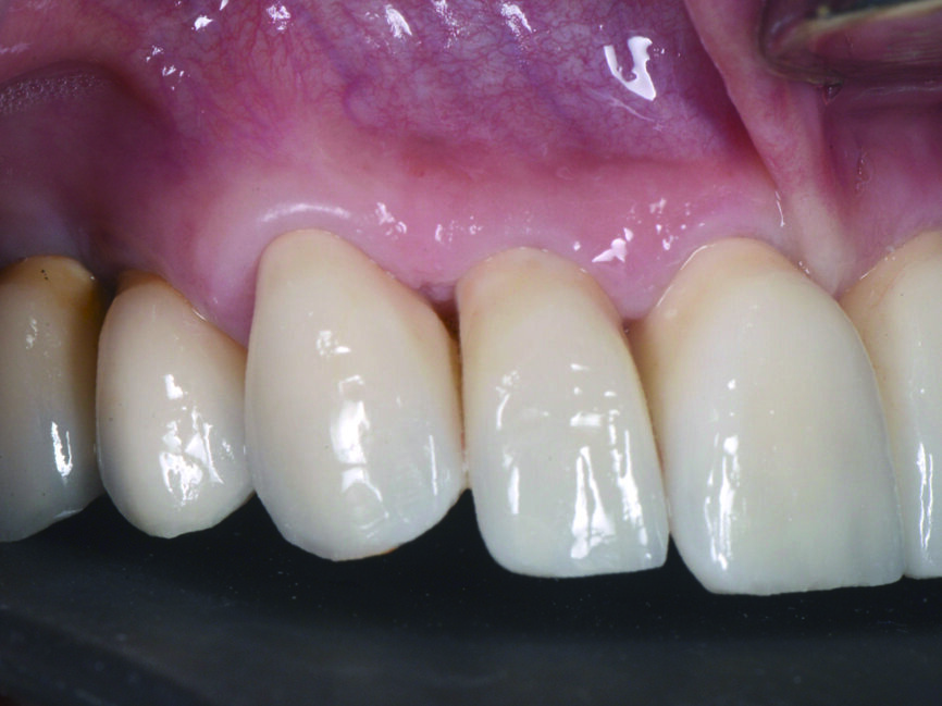 Fig. 16 : Vue détaillée postopératoire du côté droit des couronnes unitaires en zircone cubique. 