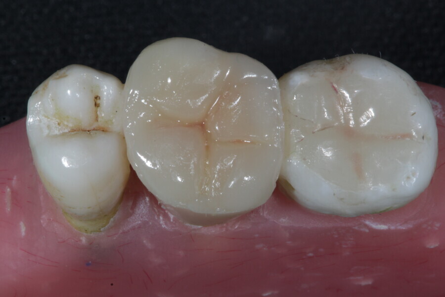 Fig. 44a: Restoration after finishing and polishing.