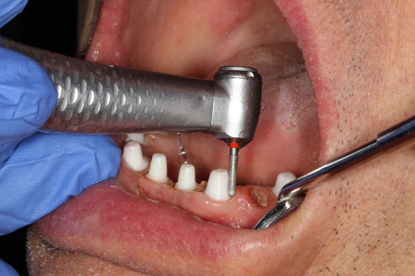 Fig. 10: Preparation of the abutment.