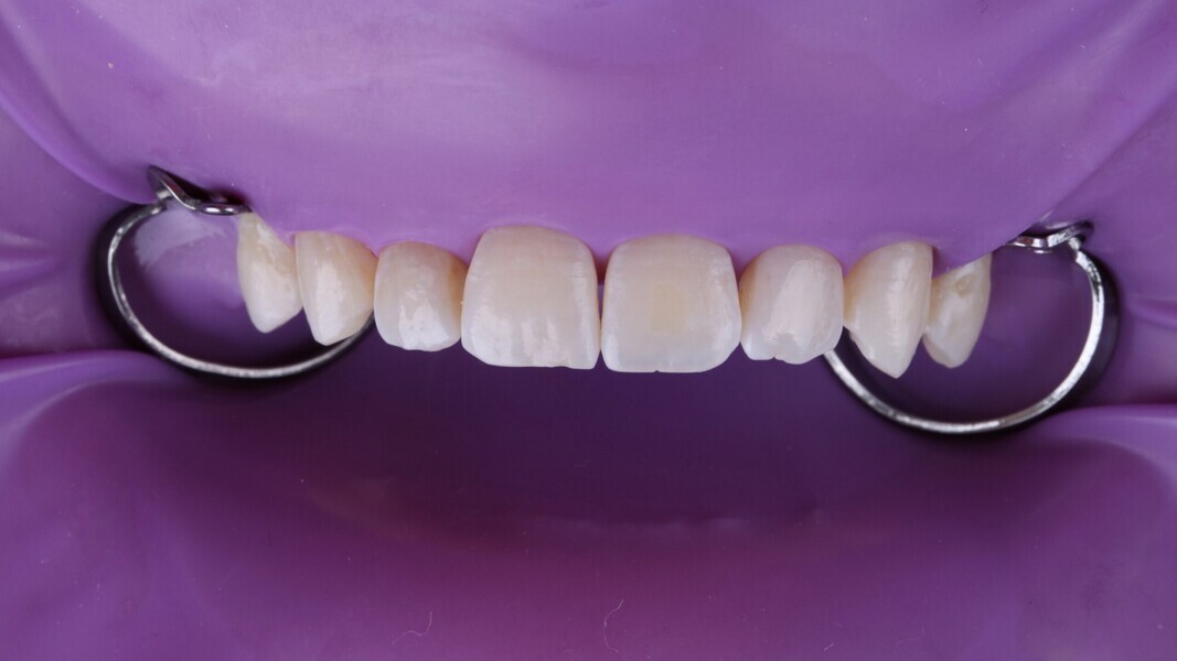 Fig. 6: Isolatie met rubberdam.