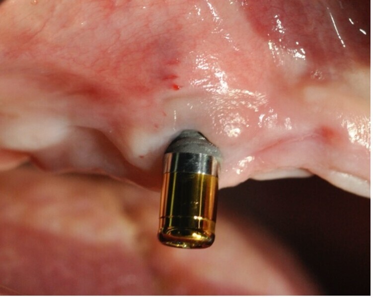 Fig. 6 : Retrait du dernier implant suspect dans la bouche de la patiente. À noter qu’une aggravation des signes dermatologique a été observée lors de la mise en place du pilier recouvert de nitrure de titane.