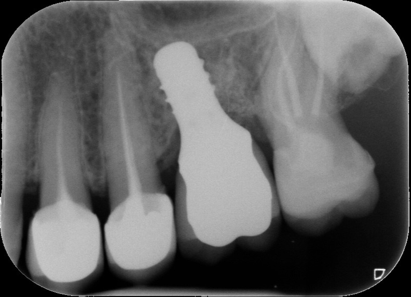 Fig. 16 : Contrôle radiographique après le scellement de l’overlay.