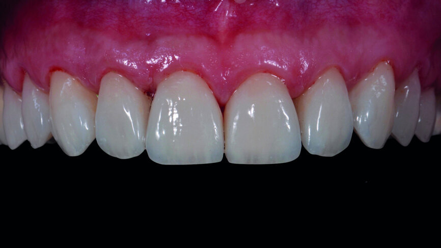 Fig. 16f: Final outcome immediately after removal of the rubber dam.