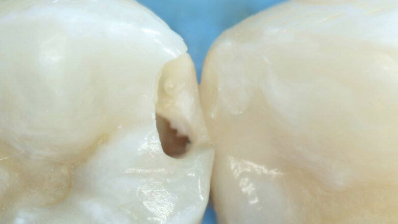 Figura 20. Después de aplicar anestesia tópica se procede con mínima apertura del esmalte 