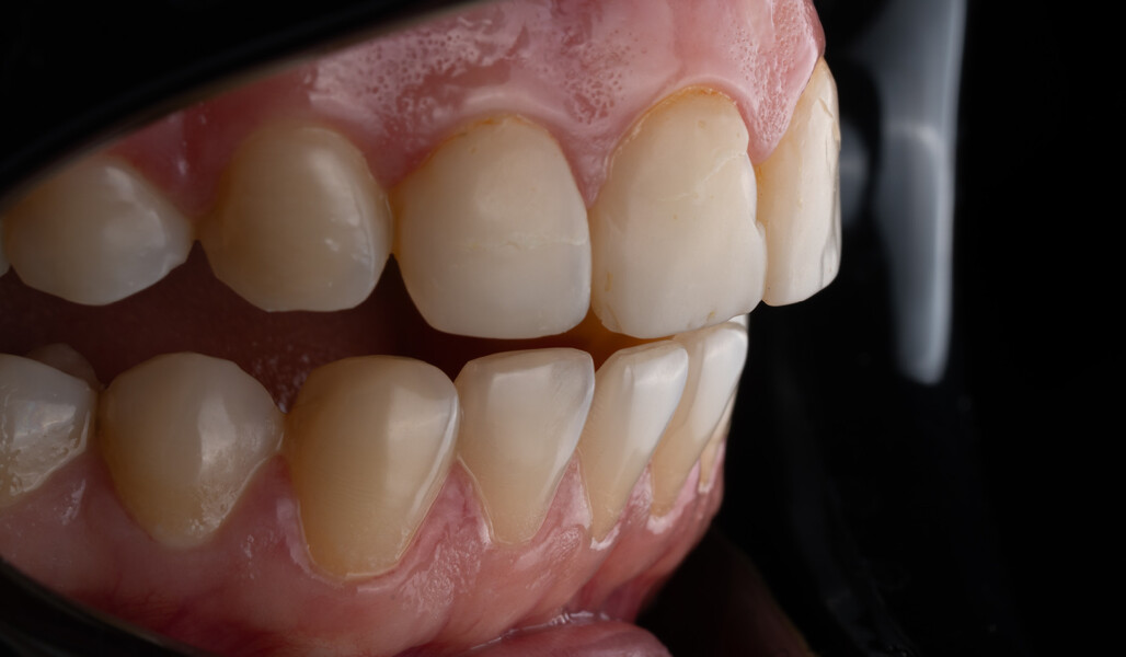 Fig. 1c: Intra-oral lateral view from the right revealing surface irregularities.