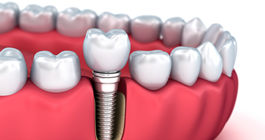 Diagnóstico, manejo y prevención de las enfermedades periimplantarias