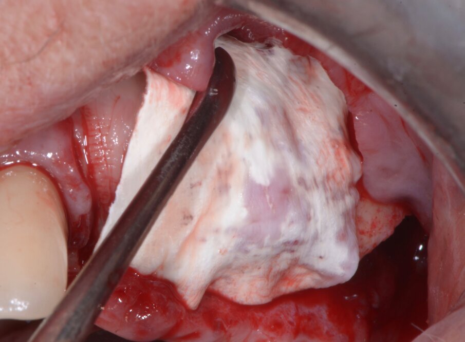 Fig. 10 - Ulteriore membrana riassorbibile a protezione dell’innesto.