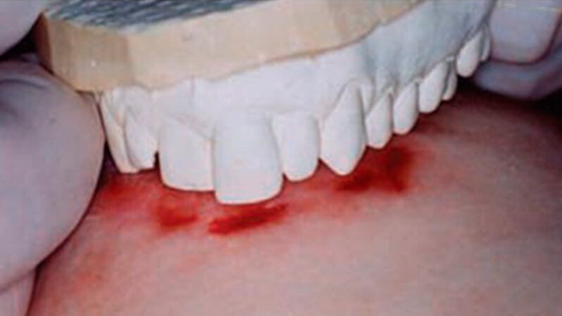 “Piano con l’attribuire ai morsi il valore di prova” dicono i ricercatori americani di Medicina legale