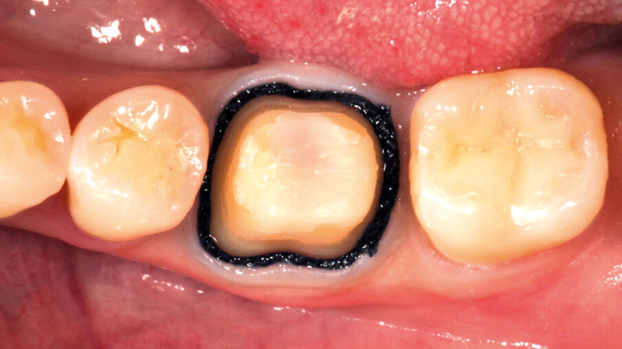 Fig. 6: In order to allow for a detailed capture of the preparation margin, the gingival tissues are retracted using the double-cord technique. Alternatively, a single cord may be applied in combination with 3M™ Astringent Retraction Paste.