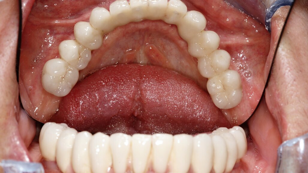 Natychmiastowa implantacja i zaopatrzenie protetyczne pacjentów z zaawansowaną chorobą przyzębia