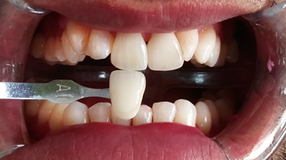 BlancOne erfindet die Zahnaufhellung neu BlancOne erfindet die Zahnaufhellung neu