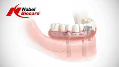 Nobel Biocare demonstrates revolutionary full-arch solution
