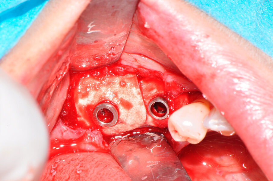Fig. 7 - Le membrane in collagene sono posizionate attorno agli impianti dopo averle opportunamente forate.