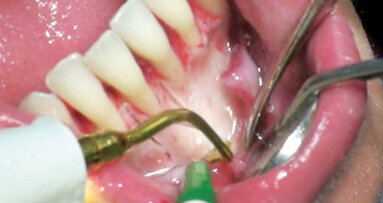 Šest klíčů pro účinné využití alveolární kortikotomie