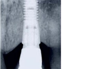 New, five-year data confirm maintained bone levels and biological sustainability with OsseoSpeed implants