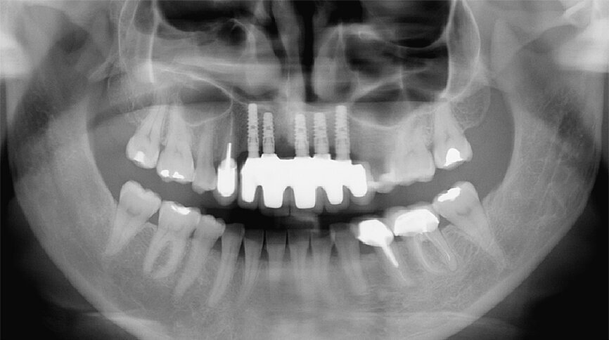 Fig. 40: Radiographic check-up after seven years.