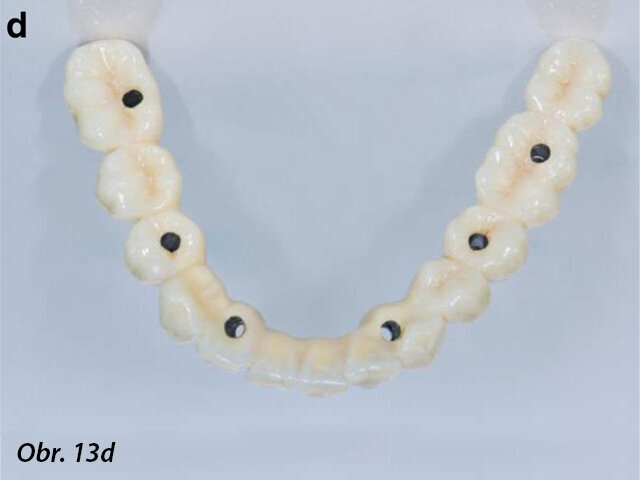 Chromkobaltová základní konstrukce vyrobená pomocí CAD/CAM jako jeden celek před (a, b) a po fazetování kompozitem (SR Nexco Paste, Ivoclar Vivadent), tedy hotovou definitivní fixní náhradu (c, d).