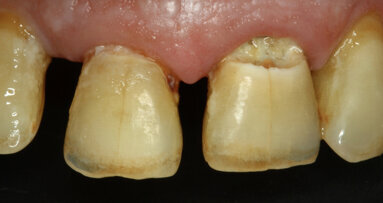 Cambio de paradigma en la remoción de caries