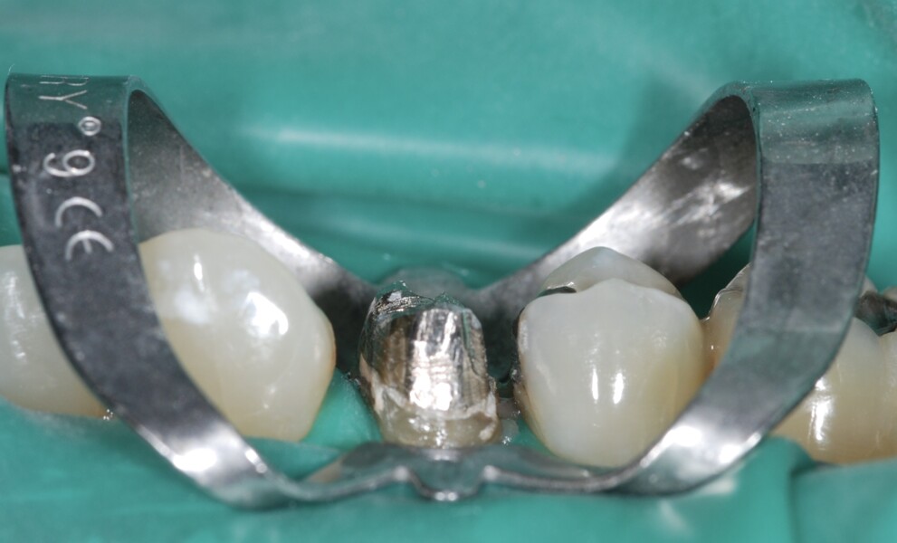 Fig. 6 : Reconstitution corono-radiculaire isolée après le retrait de la restauration prothétique.