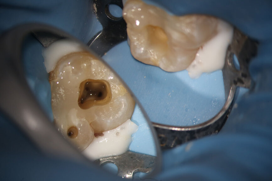 Fig. 15c: Cased treated with PIPs (Photon Induced Photoacoustic Streaming). Note the orifice barrier placed in composite to protect the endodontic treatment from coronal leakage. (Courtesy of Dr. Paula Elmi)