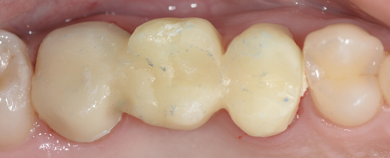 Fig. 2 : Positionnement d'un bridge temporaire en résine. 