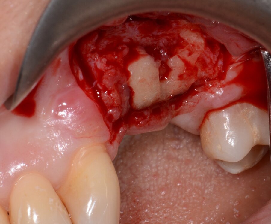 Fig. 9: Granulation tissue visible after flap elevation.