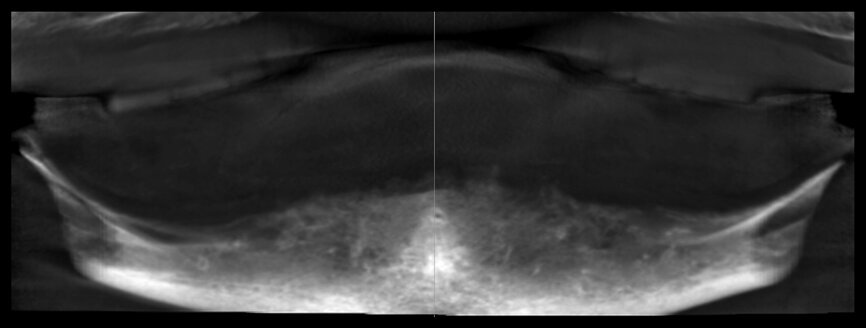 Fig. 5: Panoramic reconstruction from CBCT dataset.