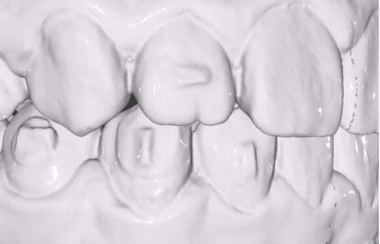 Figs. 2–3b: Poorly formed attachments and flash around attachments.