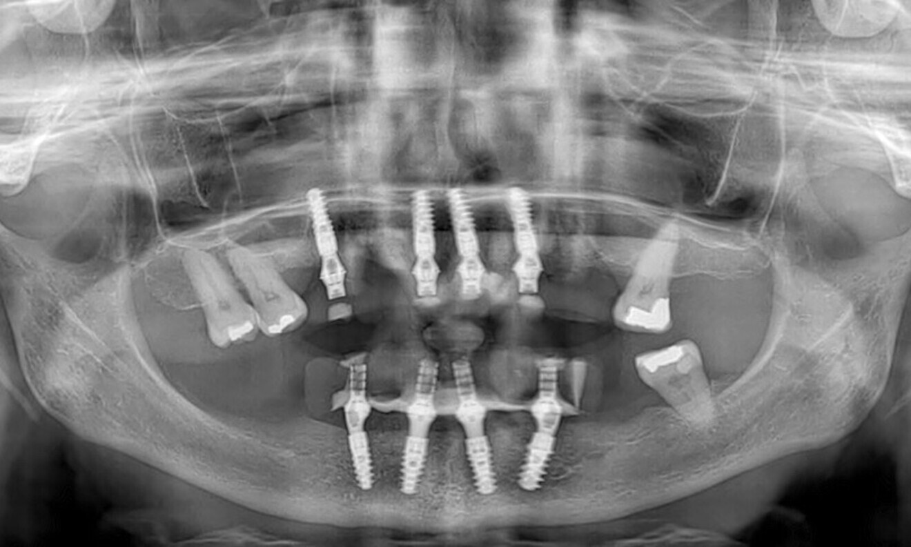 Fig. 68: ... and the radiograph confirmed proper implant positioning.