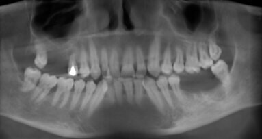 Valutazione con CBCT dell’aumento osseo verticale nella tecnica di rialzo del seno mascellare con approccio laterale: caso clinico