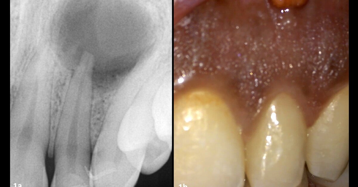 Adaptive and rotary motions in root canal treatment