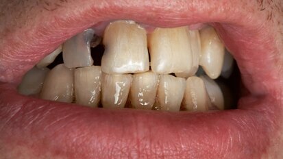 Verbindung zwischen Genen und Karies belegt Verbindung zwischen Genen und Karies belegt