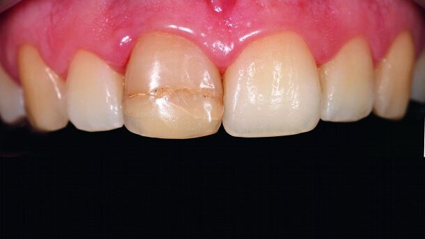 Restauration esthétique directe du secteur antérieur : concepts actuels