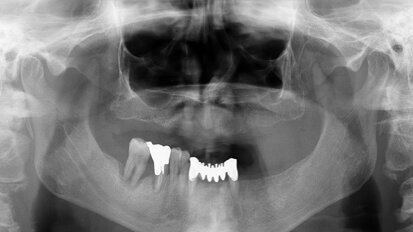 Riabilitazione implantoprotesica mandibolare immediata: un protocollo predicibile e ripetibile
