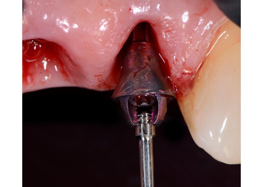 Fig. 59 - Alloggiamento SRA sul 2.2.