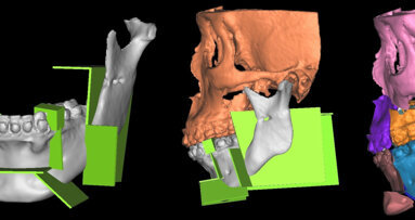 האם פרוטוקולי טומוגרפיה ממוחשבת משפיעים על הערכת המפרק הטמפורומנדיבולרי