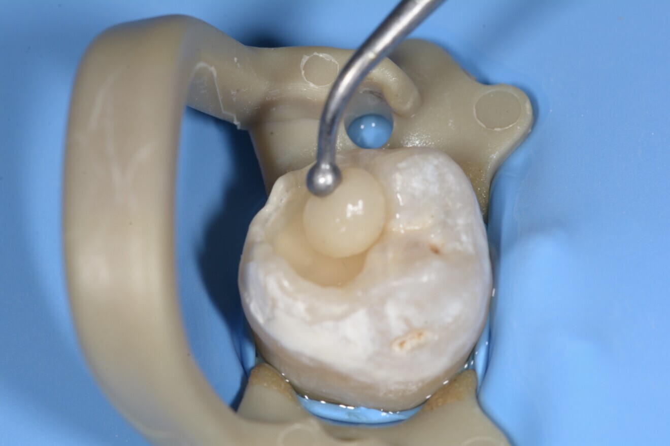 Fig. 15 : Mise en place du composite.