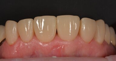 Vereenvoudigd universeel composiet voor esthetisch herstel van een zwaar gerestaureerd bovenfront