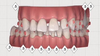 Multidisciplinární léčba u pacienta se závažnou parodontitidou