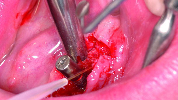 The TwinLight approach to peri- implantitis