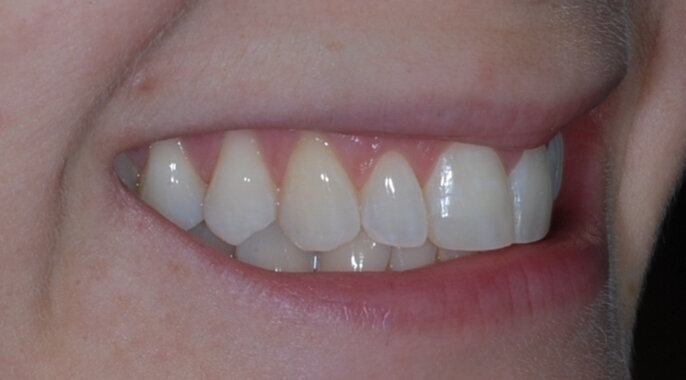 Fig. 16: Post treatment right lateral