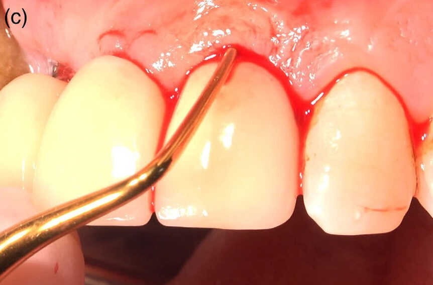 Fig1 (c) : Dégranulation du tissu sans toucher à la surface des implants.