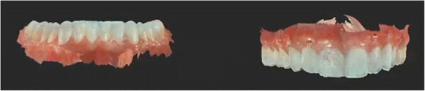 Fig. 8. Escaneo intraoral pre-tratamiento con el Carestream 3600.